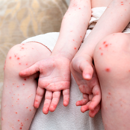 А вдруг это энтеровирус?